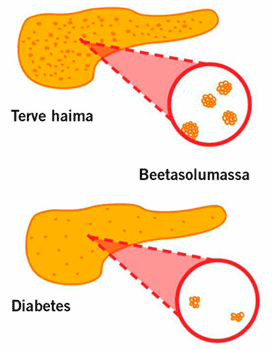Diabeteksen vaikutus haiman beetasolumassaan. Diabetesta sairastavalla haiman beetasolumassa on pienentynyt, eivätkä jäljelle jääneet solut pysty enää tuottamaan riittävästi insuliinia veren glukoositason ylläpitämiseksi (Souza ym. 2006 mukaan).